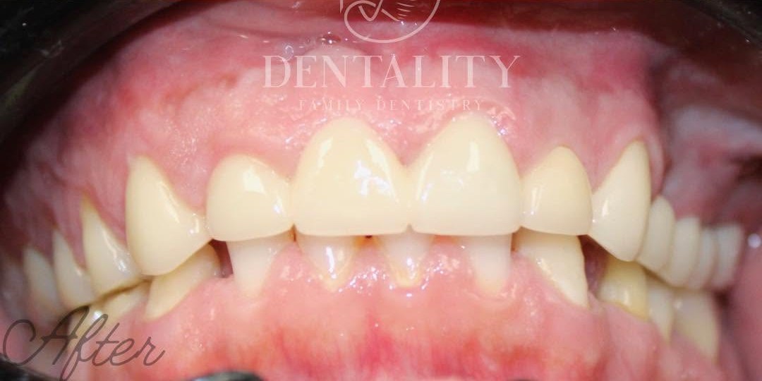 After treatment