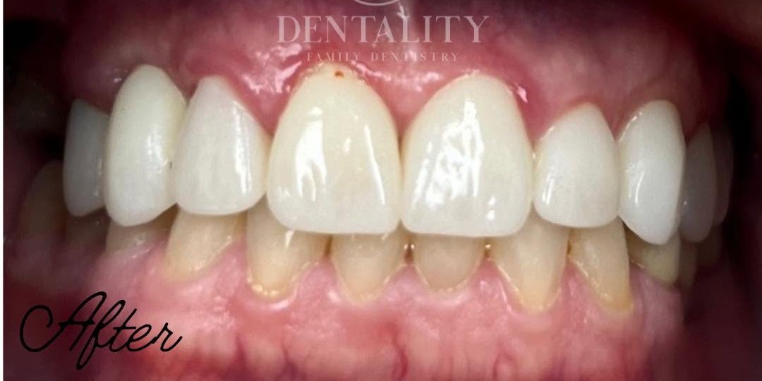 After treatment