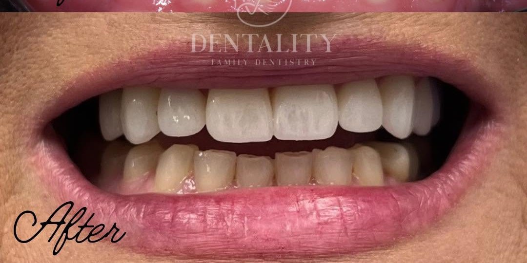 After treatment