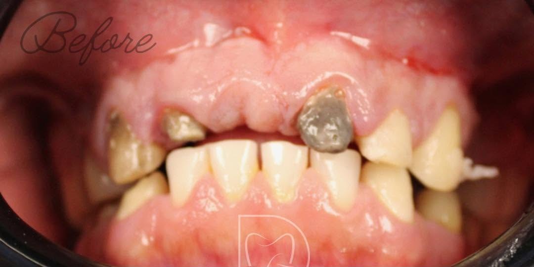 Before treatment