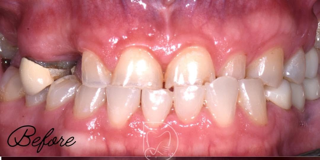 Before treatment