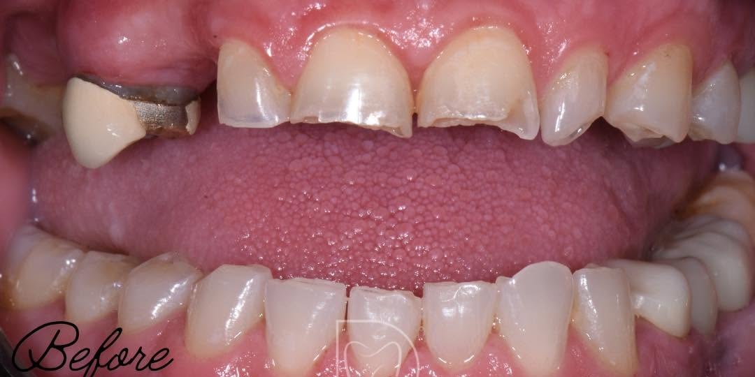 Before treatment